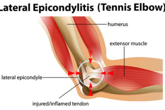 Lateral Epicondylitis or tennis elbow illustration